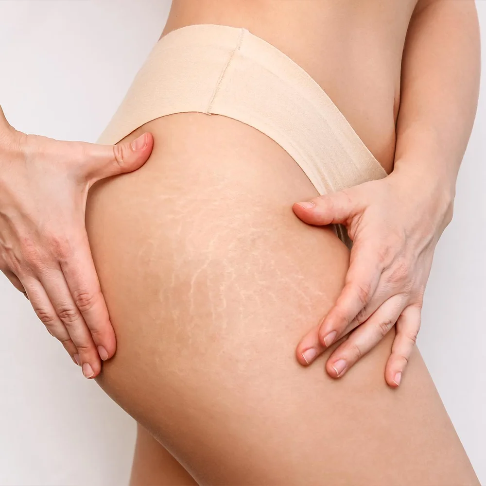 Camuflagem de Estrias