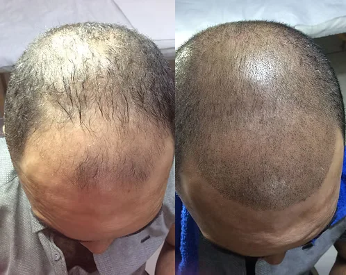 Micropigmentação Capilar Paula Colini