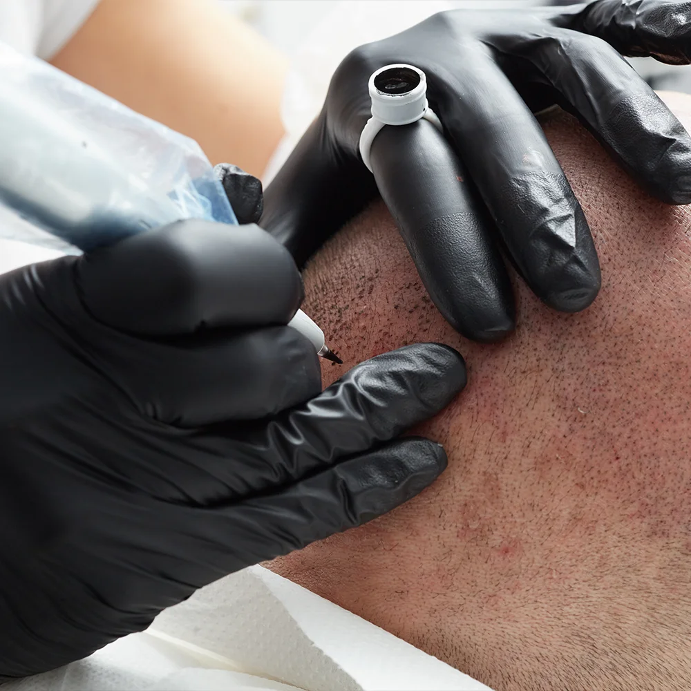 Micropigmentação Capilar